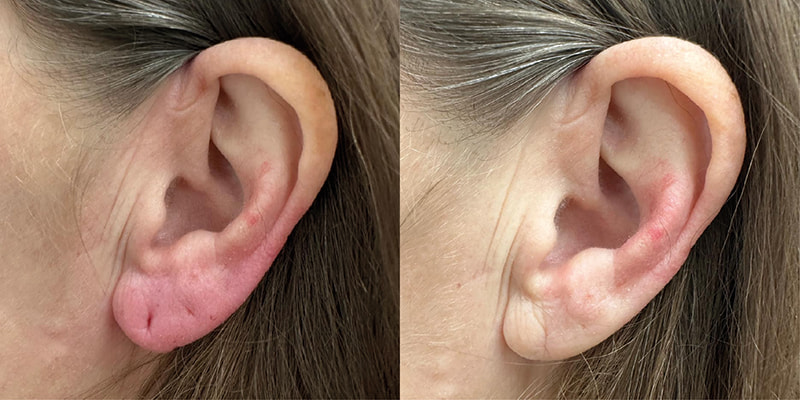 manchester earlobe filler patient before and after