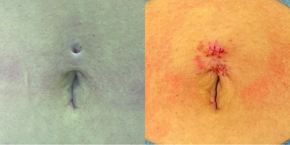 Belly Button Piercing Repair Before & After Image