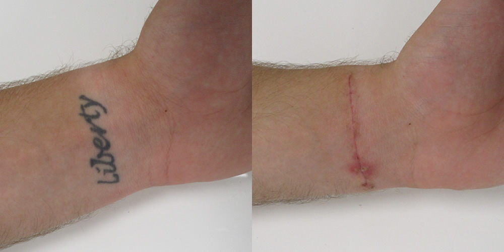 Tattoo Excision Before & After Image