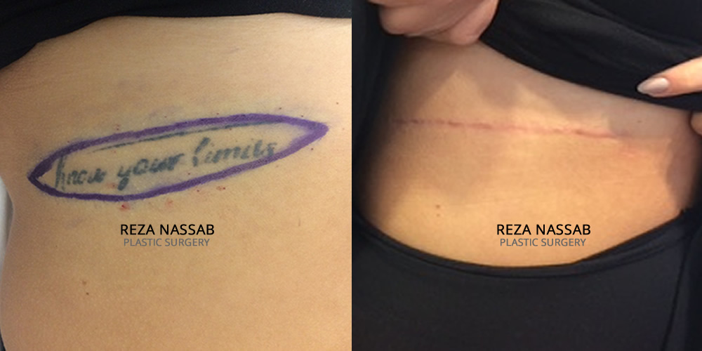 Tattoo Excision Before & After Image