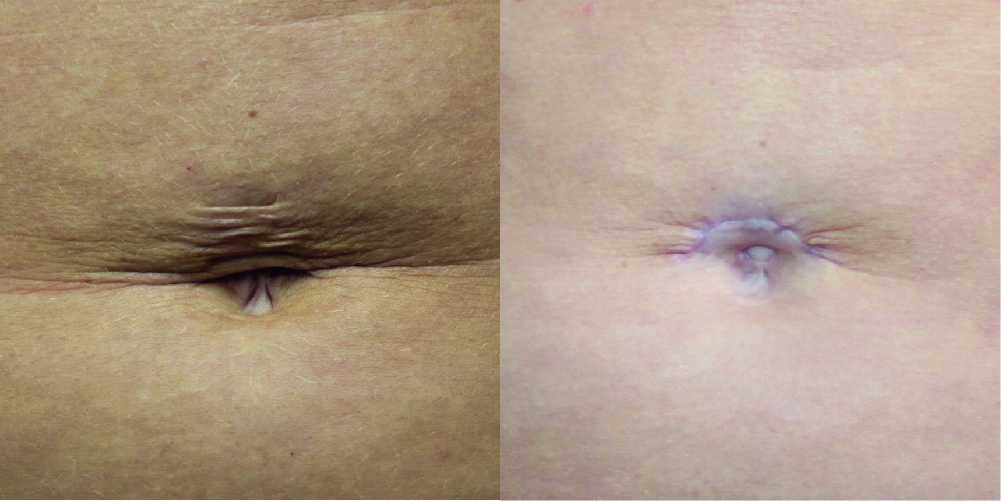 Umbilical Lift Before & After Image
