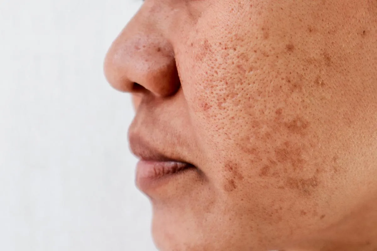 does glutathione cause skin cancer Glutathione The Secret of Skin Health - CLNQ Manchester | Cheshire